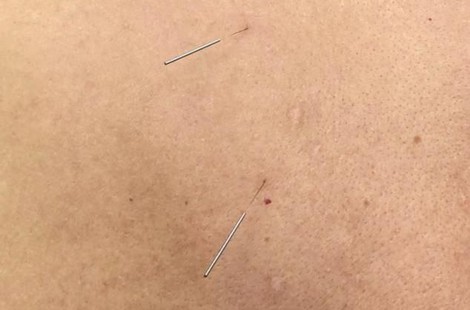 Иглорефлексотерапия