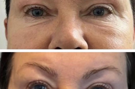 PDRN, сильнейший омолаживающий состав аминокислот