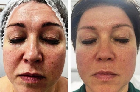 PDRN, сильнейший омолаживающий состав аминокислот