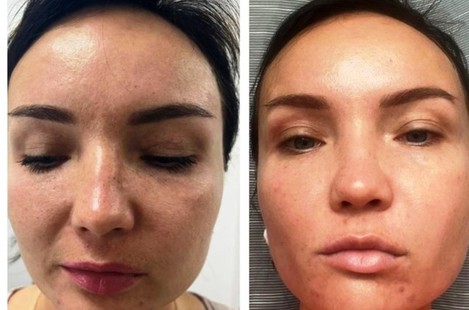 PDRN, омоложение и восстановление тканей сильнейшим пептидным составом аминокислот