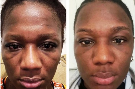 PDRN, омоложение и восстановление тканей сильнейшим пептидным составом аминокислот