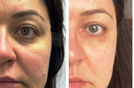 PDRN, омоложение тканей