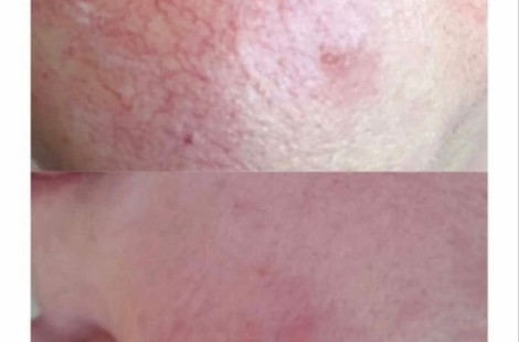 PDRN, устранение купероза