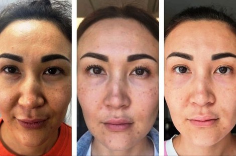 PDRN, сильнейший омолаживающий состав аминокислот