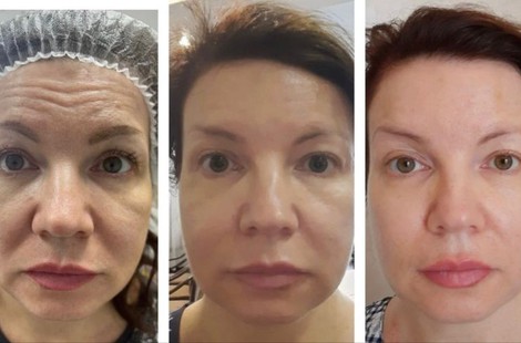 PDRN, омоложение и восстановление тканей сильнейшим пептидным составом аминокислот