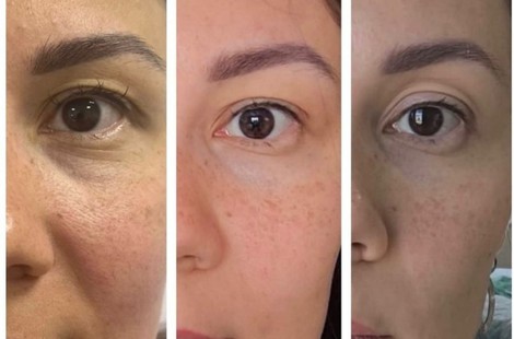 PDRN, омоложение и восстановление тканей сильнейшим пептидным составом аминокислот