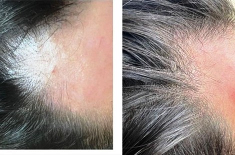 Трихология: возрождение волосяного фолликула, рост и укрепление волос