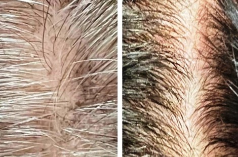 Hair-трихология: возрождение волосяного фолликула, рост и укрепление волос